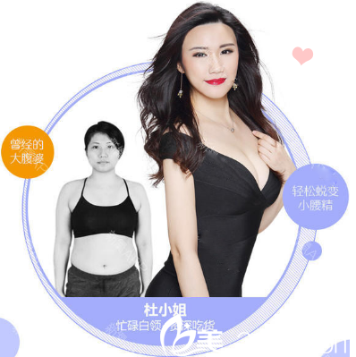 廣州美萊王志軍腰腹環(huán)吸案例 廣州美萊王志軍腰腹環(huán)吸案例