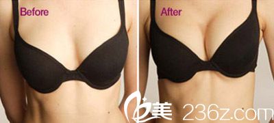 韓國嫵麗整形外科假體隆胸真人案例