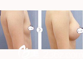 金允石院長假體隆胸前后對比