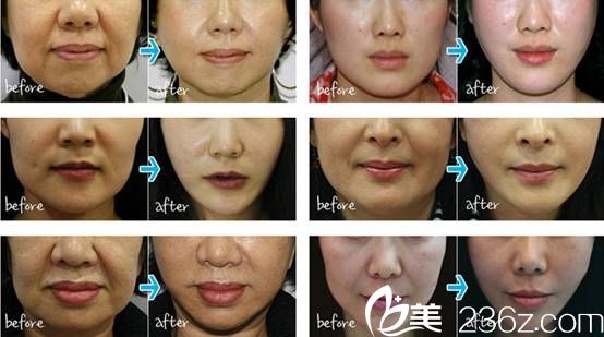 禹政浩院長親自手術(shù)術(shù)后效果