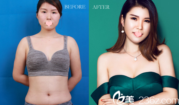 廣州美萊<!--<i data=20240703-sp></i>-->內(nèi)窺鏡假體隆胸案例