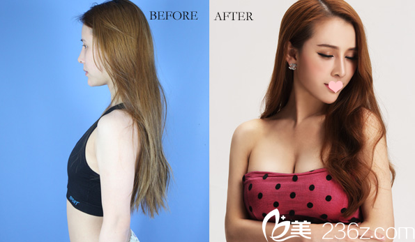 廣州美萊<!--<i data=20240703-sp></i>-->自體脂肪隆胸案例