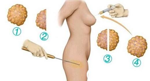 韓國伊美芝整形醫(yī)院自體脂肪移植 韓國伊美芝整形醫(yī)院自體脂肪移植