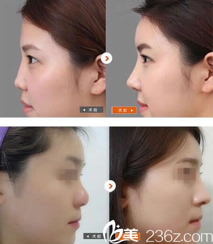 包頭華美隆鼻效果案例