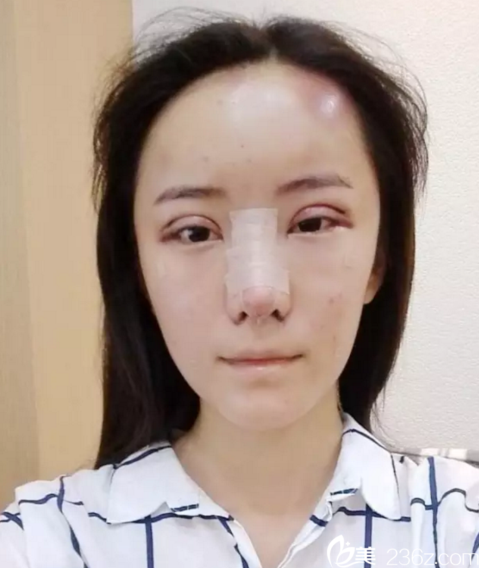 手術(shù)后第2天