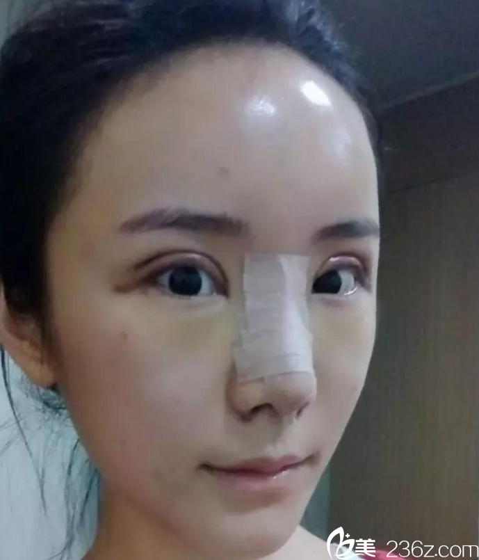 術(shù)后第7天，mm要來(lái)醫(yī)院拆線了