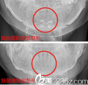 韓國嫵麗面部輪廓整形好不好？看完真人案例你就知道了