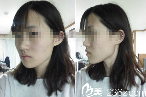 韓國嫵麗整形外科術前素顏照