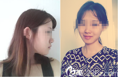 嫵麗醫(yī)院真人案例3周后