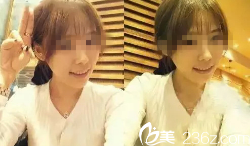 嫵麗醫(yī)院術后一個月真人案例