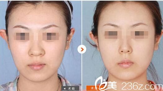 華美王金紅主任隆鼻效果