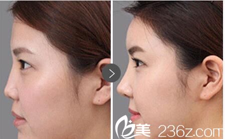 華美愛貝芙注射填充效果 華美愛貝芙注射填充效果