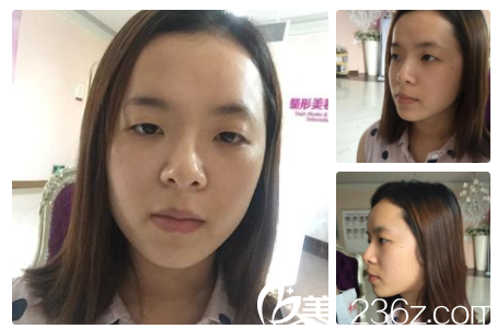 廣州美萊醫(yī)療美容整形醫(yī)院陳貴宗術(shù)前照片1