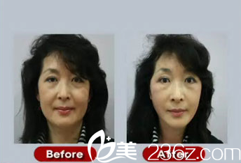 【現(xiàn)場直擊 真實(shí)還原】韓國美來可整形醫(yī)院禹政浩做面部提升術(shù)手術(shù)全過程