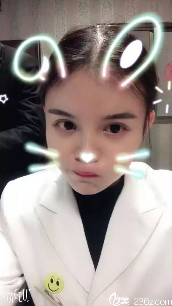 韓興斌雙眼皮真人案例效果圖