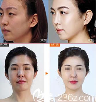 路世敏主任微整形注射效果 路世敏主任微整形注射效果