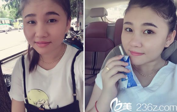 紹興維美汪峰韓式雙眼皮真人案例 紹興維美汪峰韓式雙眼皮真人案例