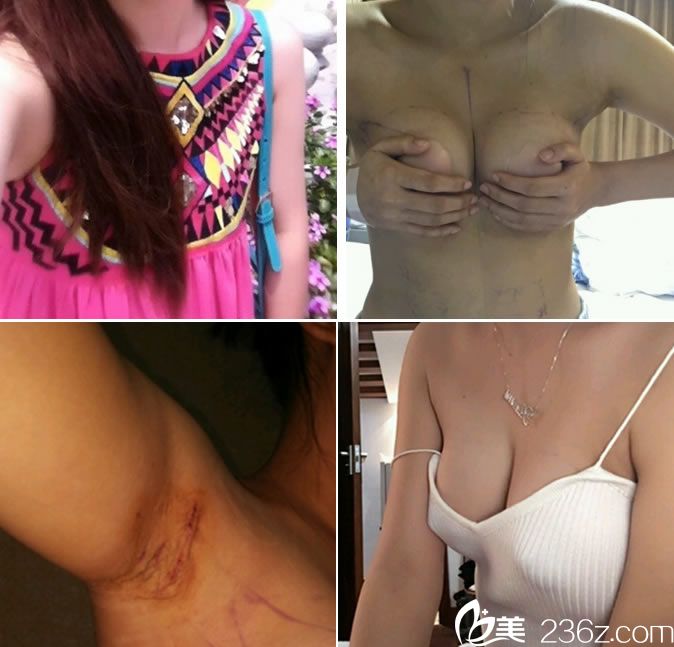 紹興維美<!--<i data=20240703-sp></i>-->院長(zhǎng)假體隆胸案例 紹興維美<!--<i data=20240703-sp></i>-->院長(zhǎng)假體隆胸案例