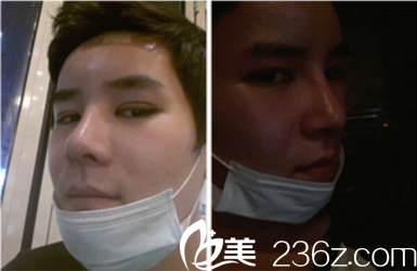 德萊茵整形外科真人案例兩周記錄 德萊茵整形外科真人案例兩周記錄