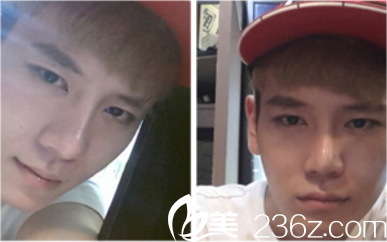 鄭裕錫院長(zhǎng)手術(shù)真人案例術(shù)后四個(gè)月 鄭裕錫院長(zhǎng)手術(shù)真人案例術(shù)后四個(gè)月