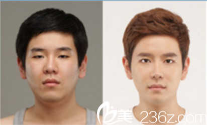 德萊茵整形外科真人案例術(shù)前術(shù)后對(duì)比 德萊茵整形外科真人案例術(shù)前術(shù)后對(duì)比