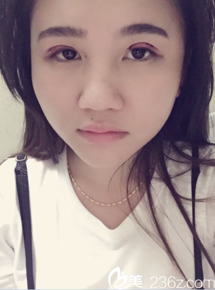 紹興維美汪峰韓式三點(diǎn)雙眼皮第1天