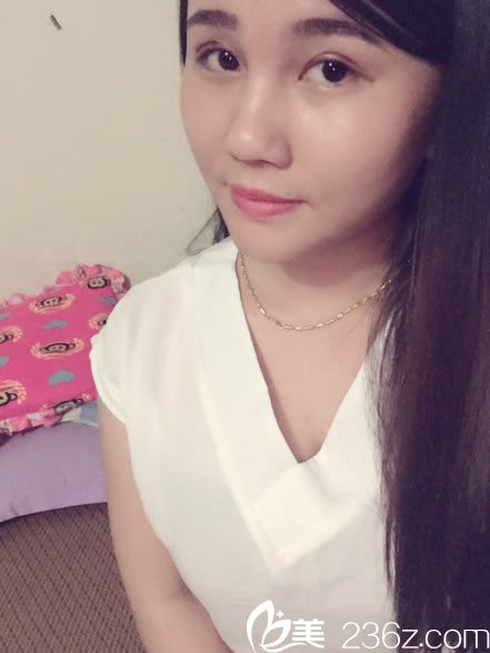 維美做韓式雙眼皮第6天恢復(fù)照