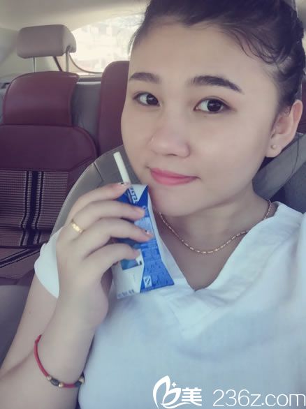 紹興維美汪峰醫(yī)生技術(shù)怎么樣？看我花2980做韓式定點(diǎn)雙眼皮14天真人案例效果