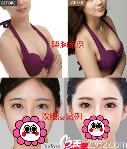 重慶華美李富強(qiáng)院長(zhǎng)真人隆胸雙眼皮案例 重慶華美李富強(qiáng)院長(zhǎng)真人隆胸雙眼皮案例