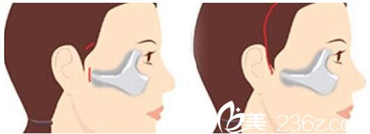 韓國美姿整形外科醫(yī)院顴骨降低術(shù) 韓國美姿整形外科醫(yī)院顴骨降低術(shù)