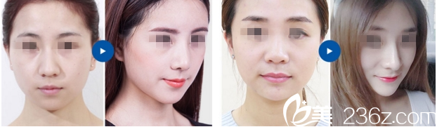 重慶華美整形張國(guó)強(qiáng)隆鼻案例 重慶華美整形張國(guó)強(qiáng)隆鼻案例