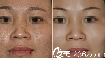 重慶華美王繼文醫(yī)生祛斑真人案例