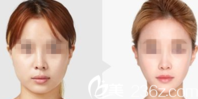 A特整形醫(yī)院案例 A特整形醫(yī)院案例