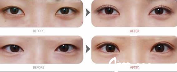 王煥雙眼皮案例對(duì)比圖