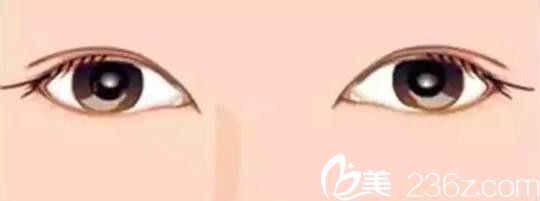 外寬內(nèi)窄的雙眼皮
