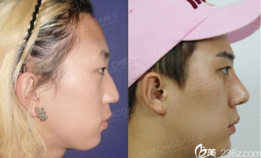 韓國清潭優(yōu)整形外科做鼻子出名嗎