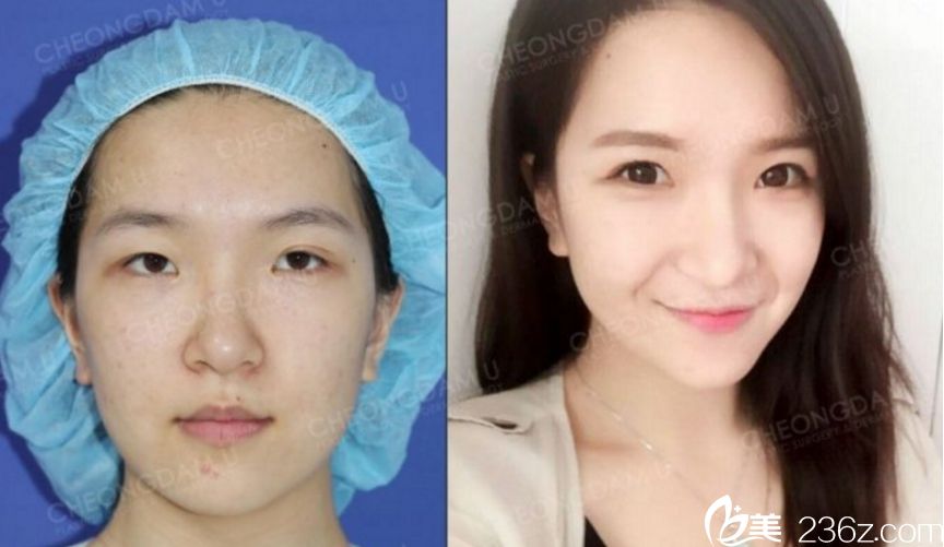 韓國清潭優(yōu)整形外科金虎吉 做鼻子出名嗎