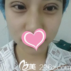 剛做完雙眼皮手術(shù)的樣子 剛做完雙眼皮手術(shù)的樣子