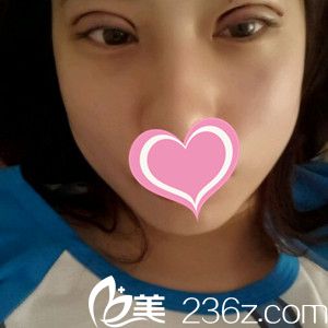 雙眼皮術(shù)后3天眼睛依然腫脹 雙眼皮術(shù)后3天眼睛依然腫脹