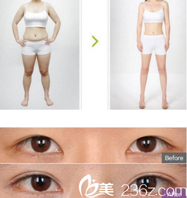 臨汾麗都金平吸脂雙眼皮案例