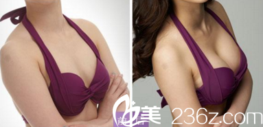 臨汾麗都整形金平醫(yī)生真人隆胸案例