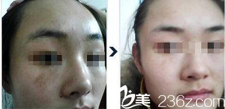 韓國清潭洞MIN CLINIC微整形外科祛斑真人案例 韓國清潭洞MIN CLINIC微整形外科祛斑真人案例