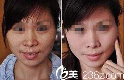 韓國清潭洞MIN CLINIC微整形外科閔永修祛斑效果好不好？激光祛斑真人案例