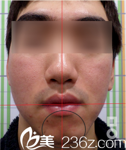 韓國美爾韓整形醫(yī)院任龍奭院長做顏面部不對稱手術(shù)怎么樣?看真人案例