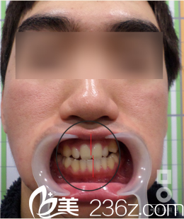 韓國美爾(miall)韓整形醫(yī)院面部不對稱矯正真人<span style= 韓國美爾(miall)韓整形醫(yī)院面部不對稱矯正真人<span style=