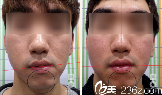 美爾韓整形醫(yī)院真人治療前后對比 美爾韓整形醫(yī)院真人治療前后對比