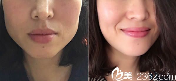 崔鯪鯉主任注射瘦臉案例