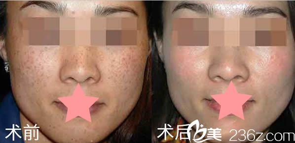 崔鯪鯉激光祛斑前后對比效果圖