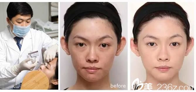 寧波美萊邵宏院長注射案例 寧波美萊邵宏院長注射案例