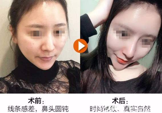 重慶美侖美奐整形施問國隆鼻案例